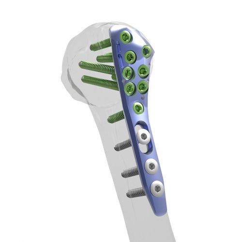 Kompressionsplatte für Humerus - Alians™ - Enovis Surgical - proximal / mit Verriegelung / Metall