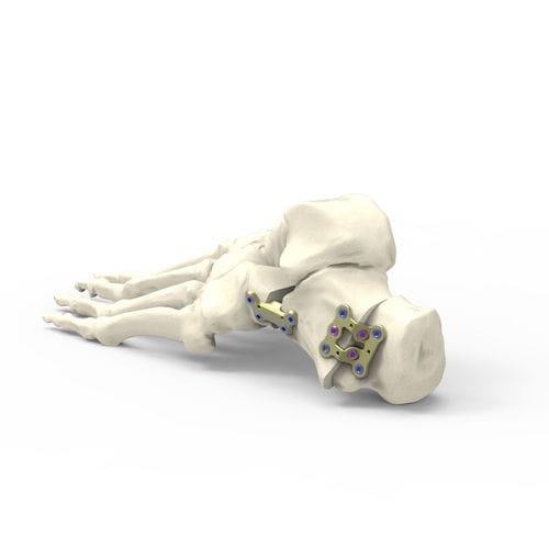Osteotomieplatte für Calcaneum - FDTSDN1 - Newclip Technics - Metall