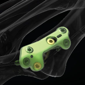 Arthrodeseplatte für Metatarsophalangealgelenk - MTP  - Newclip Technics - distal / proximal / mit Verriegelung