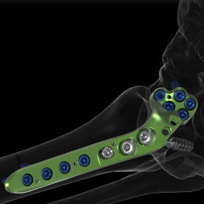 Arthrodeseplatte für Metatarsophalangealgelenk - ACTIV FUSE - Newclip Technics - anterolateral / Metall