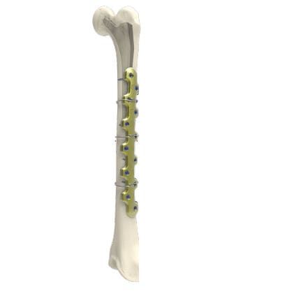 Osteotomieplatte für Oberschenkelknochen - PERIACTIV - Newclip Technics - mit Verriegelung / Metall
