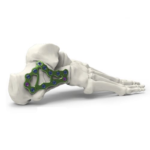 Kompressionsplatte für Calcaneum - Calcanheal - Newclip Technics - mit Verriegelung / Metall