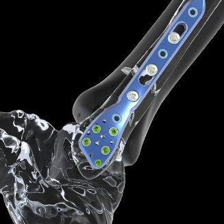 Kompressionsplatte für Tibia - FTS1 - Newclip Technics - für Fibula / für Knöchel / für Malleolus