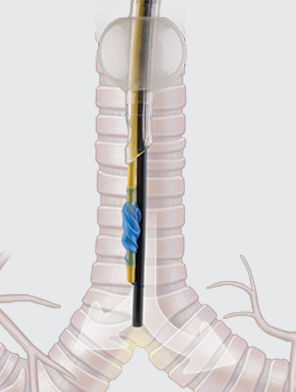 Doppellumiger Endobronchialblocker - COOK Medical - einlumig