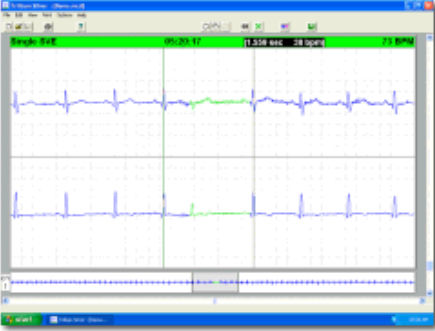 Monitoring-Software - Trillium Silver™ - Forest Medical - Analyse / medizinisch / für Langzeit-EKG