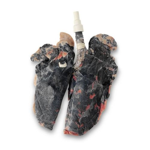 Anatomisches Lungenmodell - LS03766 - Nasco - mit Auswirkungen des Rauchens