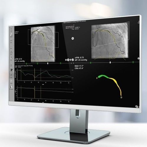 Medizinische Software - vFFR - Pie Medical Imaging - für Krankenhaus / für kardiovaskuläre Chirurgie / Analyse