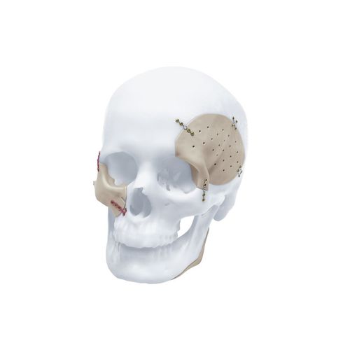 Patientenspezifisches Schädelimplantat - TRUMATCH™ - Depuy Synthes