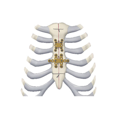 Arthrodeseplatte für Brustbein - 460 series - Depuy Synthes - für Rippen / mit Verriegelung / Titan