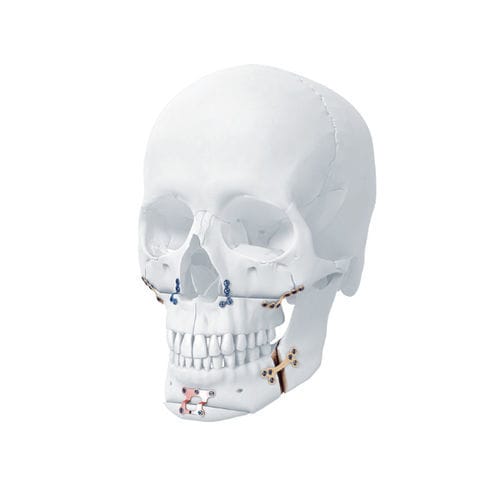 Kompressionsplatte für Unterkiefer - MatrixORTHOGNATHIC™ - Depuy Synthes - für Oberkiefer / mit Verriegelung / Metall