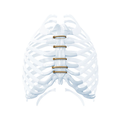 Cerclagekabel für Sternum-Verschluss - ZIPFIX™ - Depuy Synthes - Monofilament-Metall