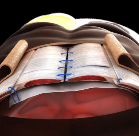 Matrix / Orthopädische Chirurgie - XCM Biologic™ - Depuy Synthes