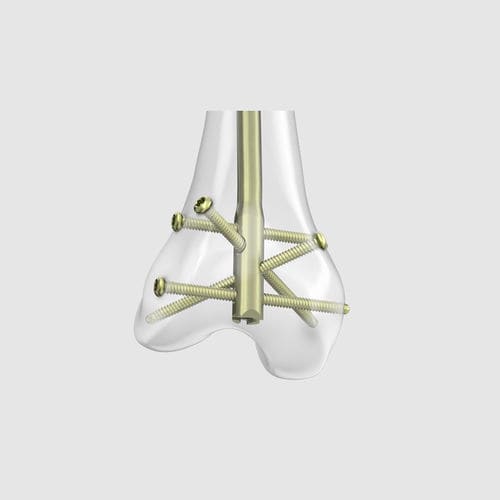 Marknagel für Oberschenkelknochen - RFN-ADVANCED™ - Depuy Synthes - mit distaler Fixierung / Metall