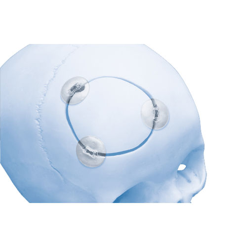 Resorbierbares Schädelfixierungssystem - RAPIDSORB™  - Depuy Synthes