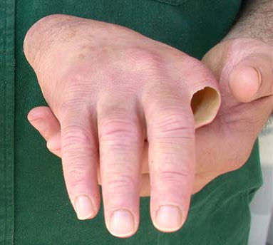 Kosmetische Handprothese - Aesthetic Prosthetics - Teil / für Erwachsene