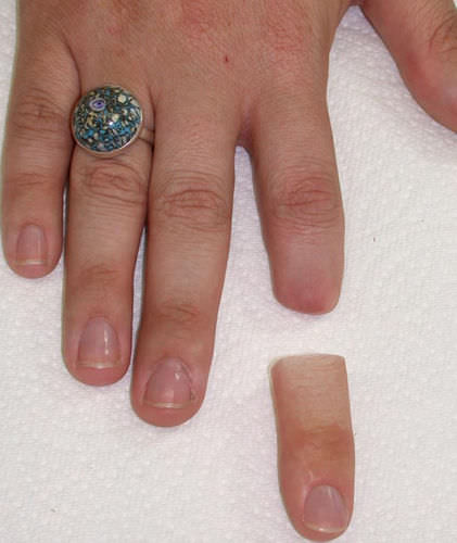 Kosmetische Fingerprothese - Aesthetic Prosthetics - für Erwachsene