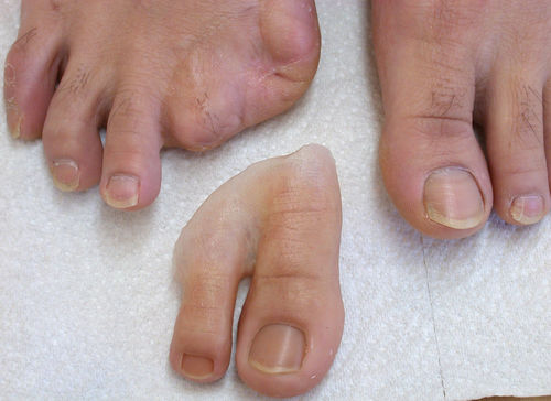 Kosmetische Zehenprothese - Aesthetic Prosthetics - für Erwachsene