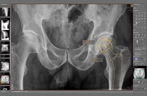 Software-Modul / Für Medizinische Bildgebung - DicomPACS® Prosthesis ...