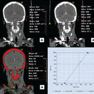 Medizinisches Software-Modul - Aquarius iNtuition - TeraRecon - für Neuroimaging / Diagnose / überwacht