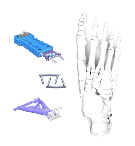 Orthopädische Klammer / für kleine Knochenfragmente - HJ-π Staple - Health-Joy Medical - für Hallux Valgus / für Arthrodese des Interphalangealgelenks des Fußes / für Osteotomie des Evans-Calcaneums