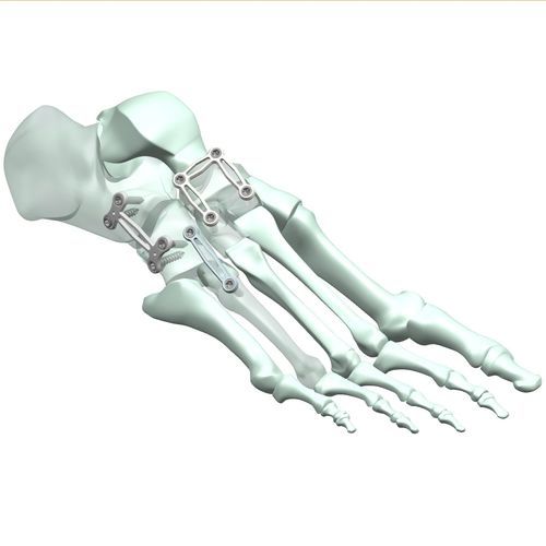 Arthrodeseplatte für tarsal-metatarsales Gelenk - HJ-Expandable 01 - Health-Joy Medical - seitlich / distal / dorsal