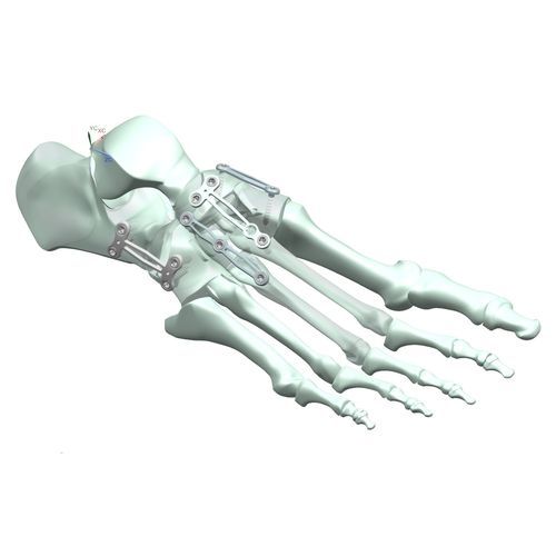 Arthrodeseplatte für Metatarsophalangealgelenk - HJ-Expandable 02 - Health-Joy Medical - für tarsal-metatarsales Gelenk / für Talonavikulargelenk / für Metatarsalknochen