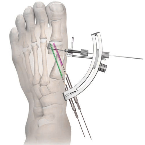 Instrumentenset / minimal-invasive Vorderfußchirurgie - HJ-Bunion  - Health-Joy Medical