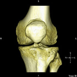 Software / Planungs für Knieprothesen - iFit® - ConforMIS - Anatomie / für orthopädische Chirurgie