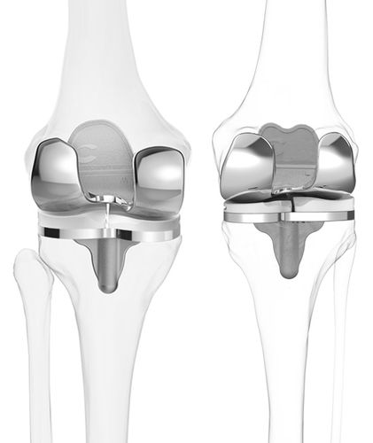 Femur-Patella Knieprothese - iTotal® CR - ConforMIS - kreuzbanderhaltend, Schlitten / zementiert