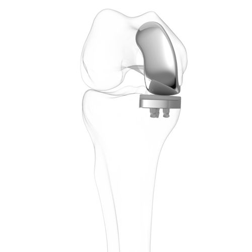 Einteilige Knieprothese - iUni®  - ConforMIS - mit fester Scheibe / zementiert