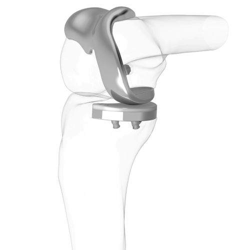 Einteilige Knieprothese - iDuo®  - ConforMIS - mit fester Scheibe / zementiert