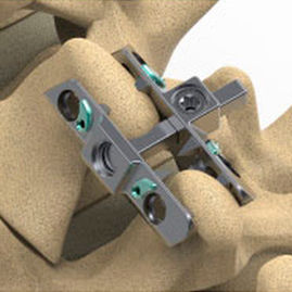 Interspinales Wirbelkörperimplantat / LWS - Reli™ SP - Precision Spine - Kreuzbein / Thorax