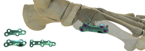 Arthrodeseplatte für Metatarsophalangealgelenk - MEDIALMAX™ - Wright Medical Technology - medial / Metall