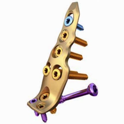 Kompressionsplatte für Fibula - ORTHOLOC™ - Wright Medical Technology - distal / mit Verriegelung / ohne Verriegelung