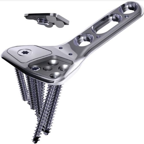 Kompressionsplatte für Radius - COVERLOC™ - Wright Medical Technology - distal / mit Verriegelung / Metall
