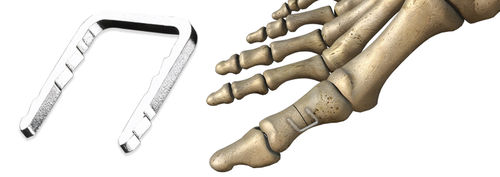 Orthopädische Klammer / für Vorfuß - CHARLOTTE™ - Wright Medical Technology - nicht resorbierbar