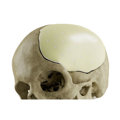 Patientenspezifisches Schädelimplantat - CROWN  - EUROS