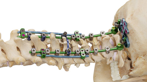 Okzipito-zervikothorakales Stabilisierungssystem für Osteosynthese - Invictus® OCT - Alphatec Spine - dorsaler Zugang / für Erwachsene
