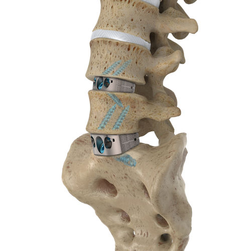 Lumbal-Sakral-Zwischenwirbelimplantat - IdentiTi™ ALIF Standalone - Alphatec Spine - ventraler Zugang / Titan