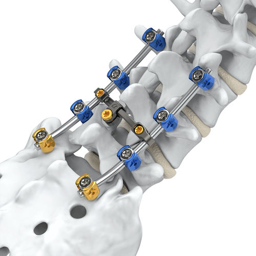 Stabilisierungssystem für Osteosynthese / Lumbal-Sakral - Arsenal™  - Alphatec Spine - dorsaler Zugang / für Erwachsene