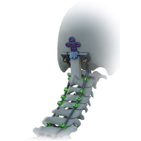 Okzipito-zervikales Stabilisierungssystem für Osteosynthese - Avalon® - Alphatec Spine - dorsaler Zugang / für Erwachsene