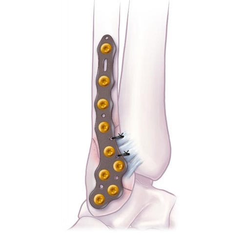 Kompressionsplatte für Fibula - VOLITION™  - Ortho Solutions - für Malleolus / distal / seitlich