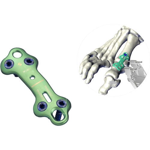 Arthrodeseplatte für Vorfuß - UltOS™ - Ortho Solutions - für Zehenglied / mit Verriegelung / ohne Verriegelung