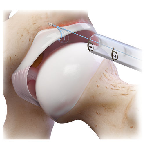 Fadenanker / labrum acetabularum - FiberTak® - Arthrex - nicht resorbierbar / ohne Naht
