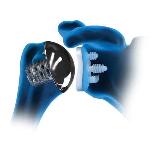 Zementierte oder zementfreie Schulterprothese - Eclipse™ - Arthrex