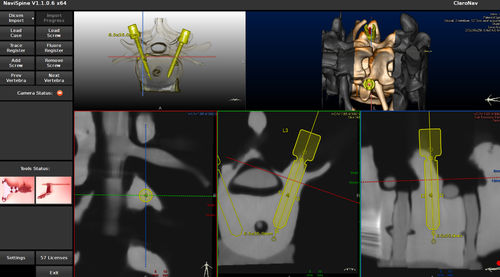 Software für roboterassistierte Chirurgie - NAVIX - Claron Technology - chirurgische Navigation / Wirbelsäule