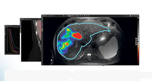 Computertomographie-Software - MIM SurePlan™ LiverY90 - MIM Software - TEP / SPECT / Onkologie