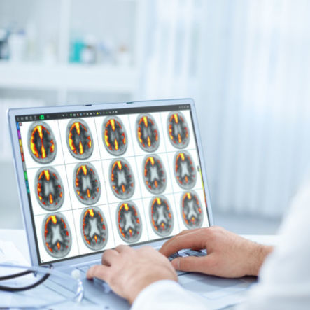 Software für Neuroimaging - MIMneuro® - MIM Software - Analyse / 3D-Visualisierung / Diagnose
