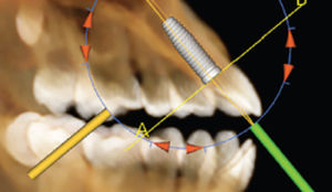Software-Modul / für Dentalimplantologie - Anatomage - 3D-Visualisierung / Planung / dental- implantologische Planung