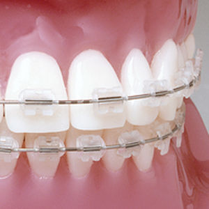 Orthodontie Bracket / ästhetisch - Prism™ - G&H Orthodontics - transparent